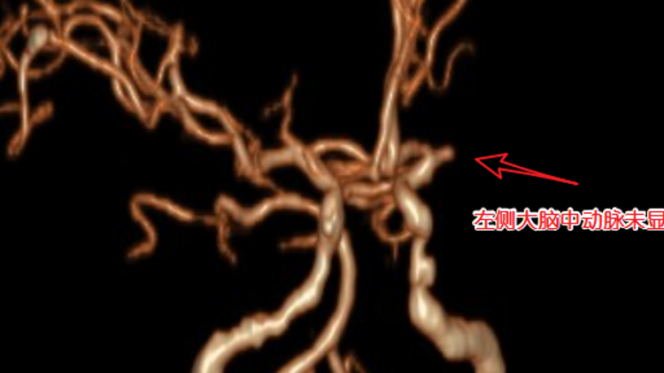 39歲男子長(zhǎng)期熬夜中風(fēng)偏癱,！這些不良生活習(xí)慣要改掉……